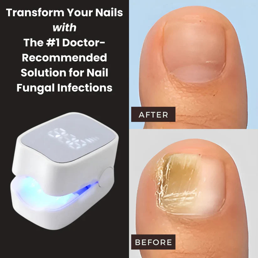 Imperial™ - Nail Fungus Laser Device