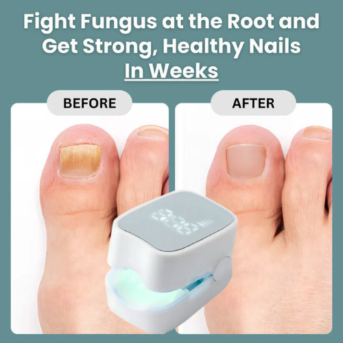 Imperial™ - Nail Fungus Laser Device