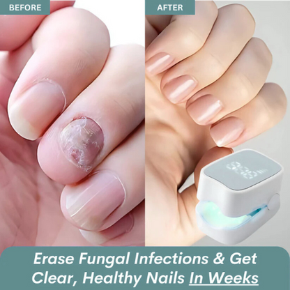 Imperial™ - Nail Fungus Laser Device